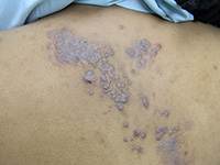 Herpes Zoster (Shingles)